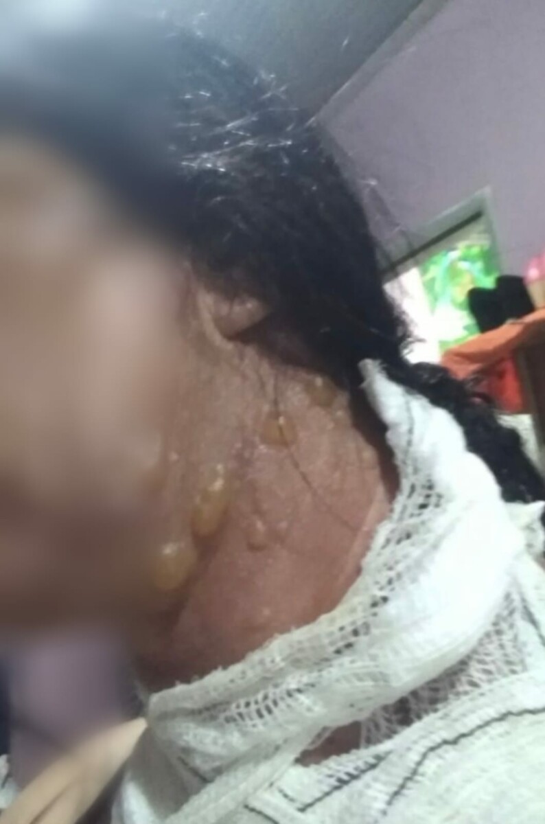 Polícia Civil prende homem que jogou café quente na companheira e causou queimaduras de segundo grau, em Jataí